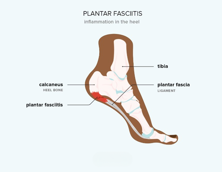 plantar-fasciitis